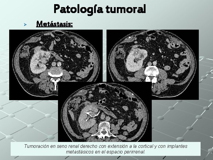 Patología tumoral Ø Metástasis: Tumoración en seno renal derecho con extensión a la cortical