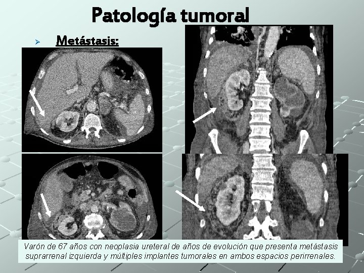 Patología tumoral Ø Metástasis: Varón de 67 años con neoplasia ureteral de años de