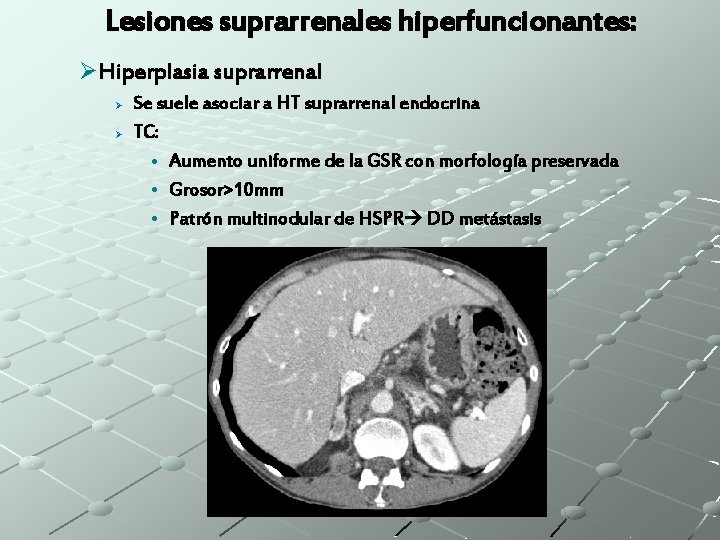 Lesiones suprarrenales hiperfuncionantes: ØHiperplasia suprarrenal Ø Ø Se suele asociar a HT suprarrenal endocrina