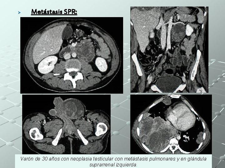 Ø Metástasis SPR: Varón de 30 años con neoplasia testicular con metástasis pulmonares y