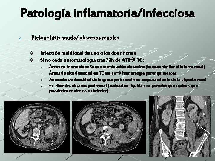 Patología inflamatoria/infecciosa Ø Pielonefritis aguda/ abscesos renales Infección multifocal de uno o los dos