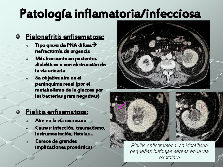 Patología inflamatoria/infecciosa Pielonefritis enfisematosa: Tipo grave de PNA difusa nefrectomía de urgencia Más frecuente