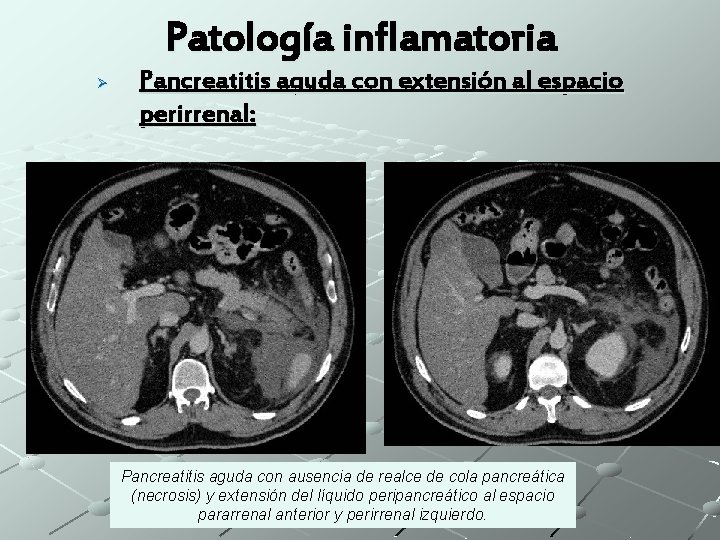 Patología inflamatoria Ø Pancreatitis aguda con extensión al espacio perirrenal: Pancreatitis aguda con ausencia