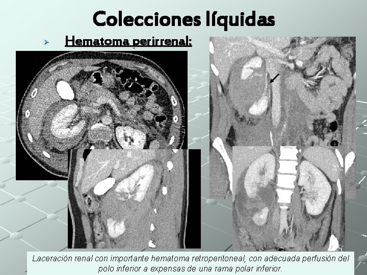 Colecciones líquidas Ø Hematoma perirrenal: Laceración renal con importante hematoma retroperitoneal, con adecuada perfusión