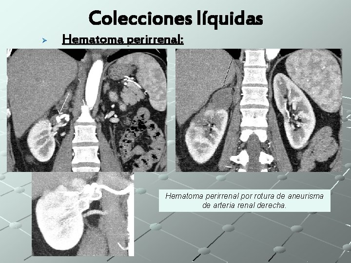 Colecciones líquidas Ø Hematoma perirrenal: Hematoma perirrenal por rotura de aneurisma de arteria renal