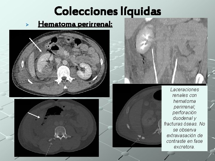 Colecciones líquidas Ø Hematoma perirrenal: Laceraciones renales con hematoma perirrenal; perforación duodenal y fracturas