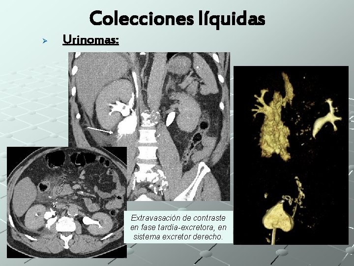Colecciones líquidas Ø Urinomas: Extravasación de contraste en fase tardía-excretora, en sistema excretor derecho.