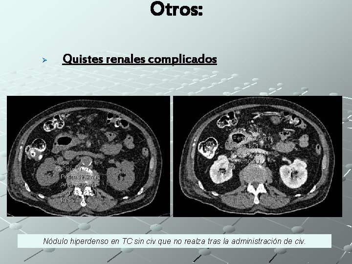 Otros: Ø Quistes renales complicados Nódulo hiperdenso en TC sin civ que no realza