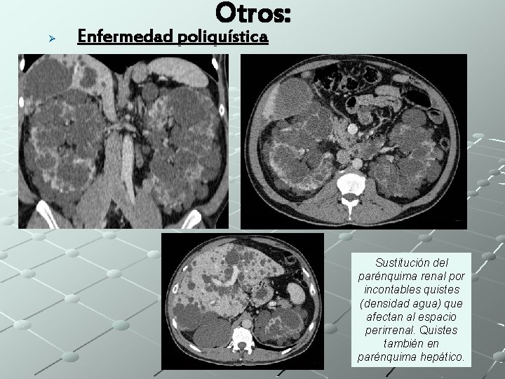 Otros: Ø Enfermedad poliquística Sustitución del parénquima renal por incontables quistes (densidad agua) que