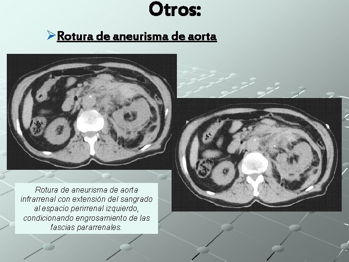Otros: ØRotura de aneurisma de aorta infrarrenal con extensión del sangrado al espacio perirrenal