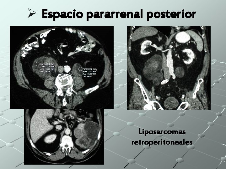 Ø Espacio pararrenal posterior Liposarcomas retroperitoneales 