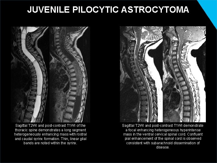 JUVENILE PILOCYTIC ASTROCYTOMA Sagittal T 2 WI and post-contrast T 1 WI of the
