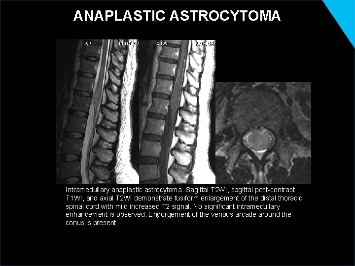 ANAPLASTIC ASTROCYTOMA Intramedullary anaplastic astrocytoma. Sagittal T 2 WI, sagittal post-contrast T 1 WI,