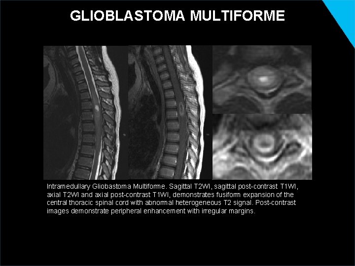 GLIOBLASTOMA MULTIFORME Intramedullary Gliobastoma Multiforme. Sagittal T 2 WI, sagittal post-contrast T 1 WI,