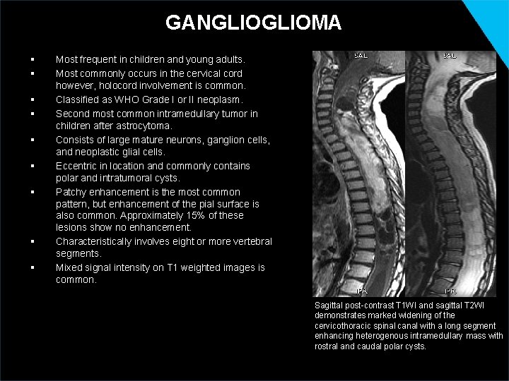 GANGLIOMA § § § § § Most frequent in children and young adults. Most