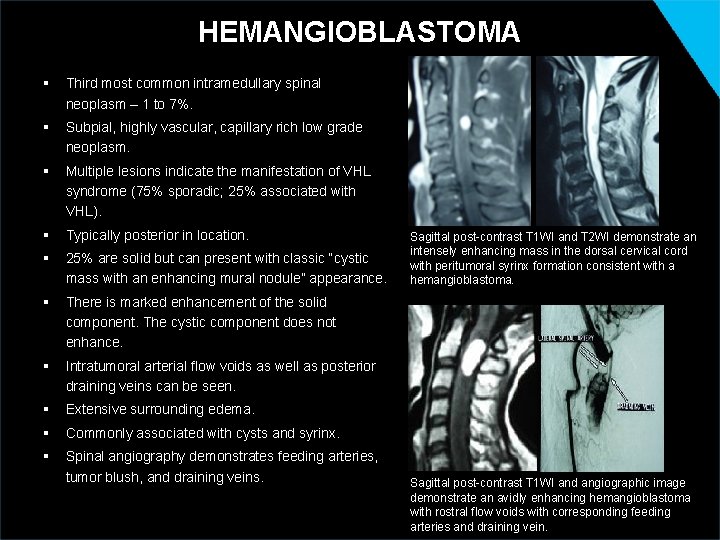 HEMANGIOBLASTOMA § Third most common intramedullary spinal neoplasm – 1 to 7%. § Subpial,