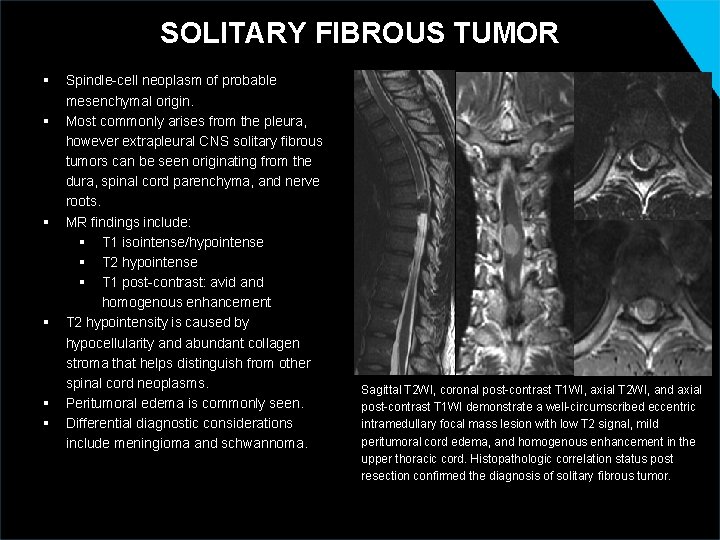 SOLITARY FIBROUS TUMOR § § § Spindle-cell neoplasm of probable mesenchymal origin. Most commonly