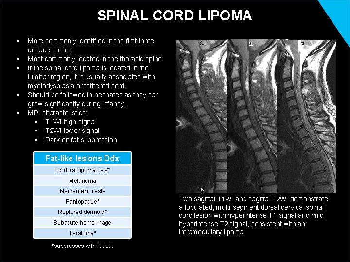 SPINAL CORD LIPOMA § § § More commonly identified in the first three decades