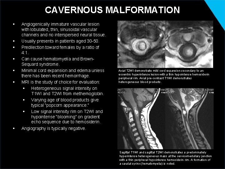 CAVERNOUS MALFORMATION § § § § Angiogenically immature vascular lesion with lobulated, thin, sinusoidal