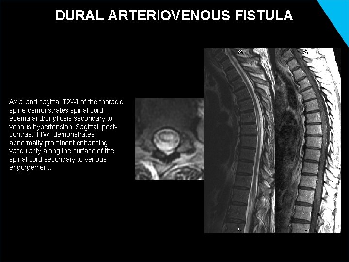 DURAL ARTERIOVENOUS FISTULA Axial and sagittal T 2 WI of the thoracic spine demonstrates