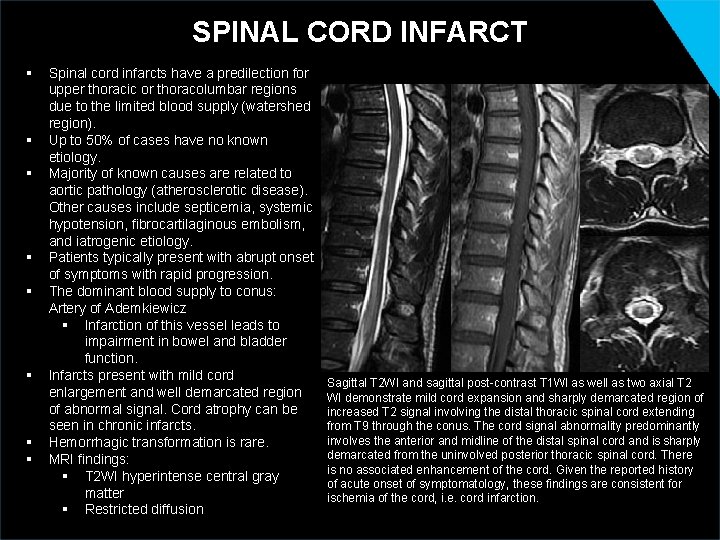 SPINAL CORD INFARCT § § § § Spinal cord infarcts have a predilection for