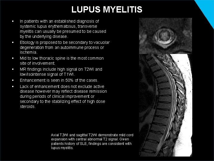 LUPUS MYELITIS § § § In patients with an established diagnosis of systemic lupus