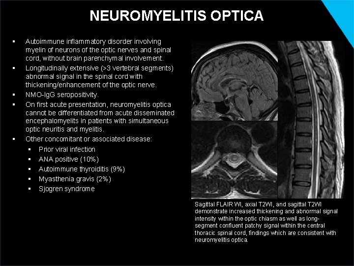 NEUROMYELITIS OPTICA § § § Autoimmune inflammatory disorder involving myelin of neurons of the