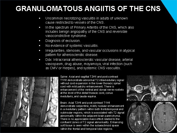 GRANULOMATOUS ANGIITIS OF THE CNS § § § Uncommon necrotizing vasculitis in adults of