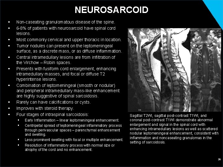 NEUROSARCOID § § § § § Non-caseating granulomatous disease of the spine. 6 -8%