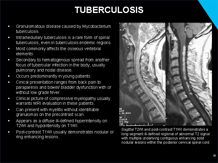 TUBERCULOSIS § § § § § Granulomatous disease caused by Mycobacterium tuberculosis. Intramedullary tuberculosis