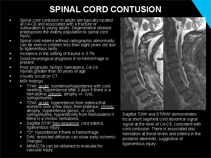 SPINAL CORD CONTUSION § § § § Spinal cord contusion in adults are typically