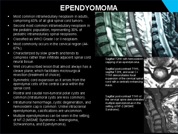 EPENDYOMOMA § § § § § Most common intramedullary neoplasm in adults, comprising 60%