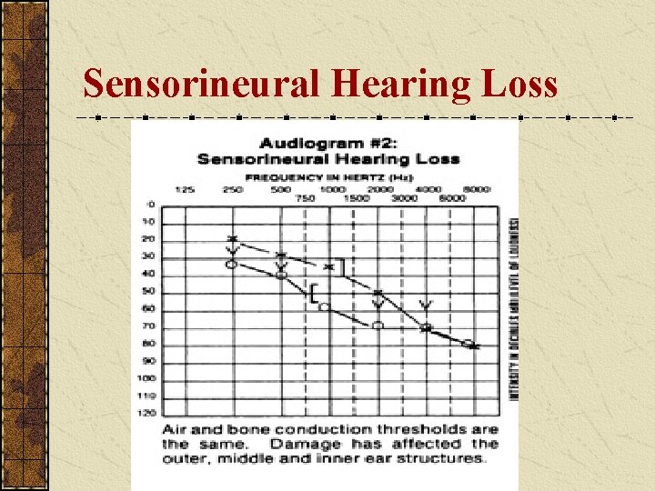 Sensorineural Hearing Loss Sensorineural Hearing Loss