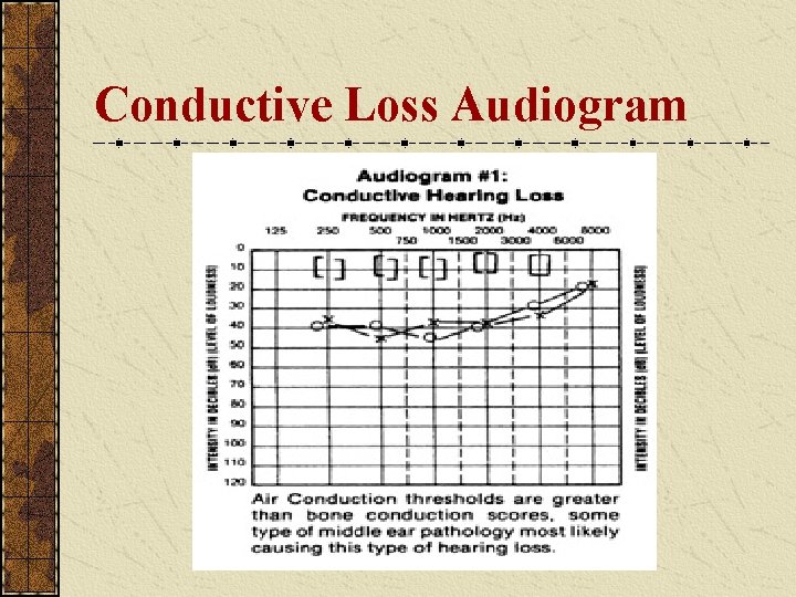 Conductive Loss Audiogram Conductive Loss Audiogram