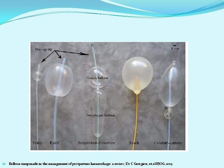  Balloon tamponade in the management of postpartum haemorrhage: a review, Dr C Georgiou,