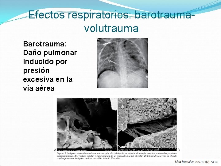 Efectos respiratorios: barotraumavolutrauma Barotrauma: Daño pulmonar inducido por presión excesiva en la vía aérea