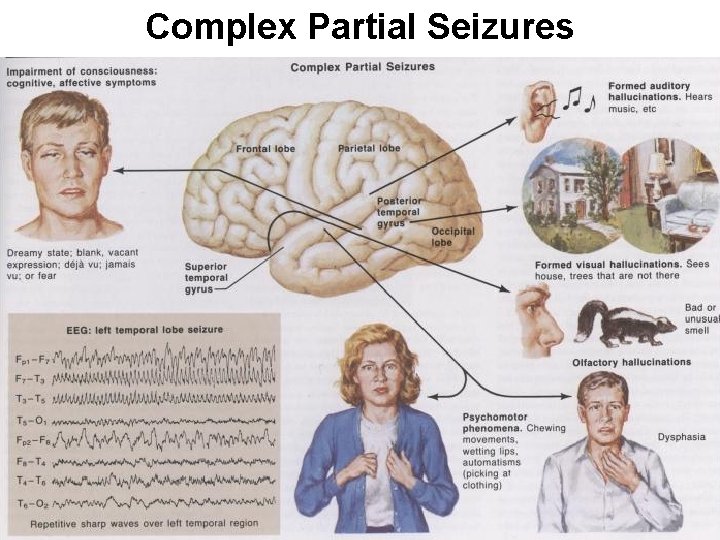 Complex Partial Seizures 