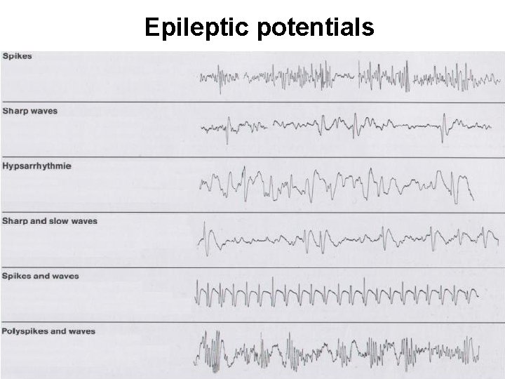 Epileptic potentials 