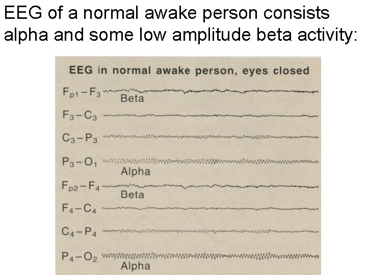 EEG of a normal awake person consists alpha and some low amplitude beta activity: