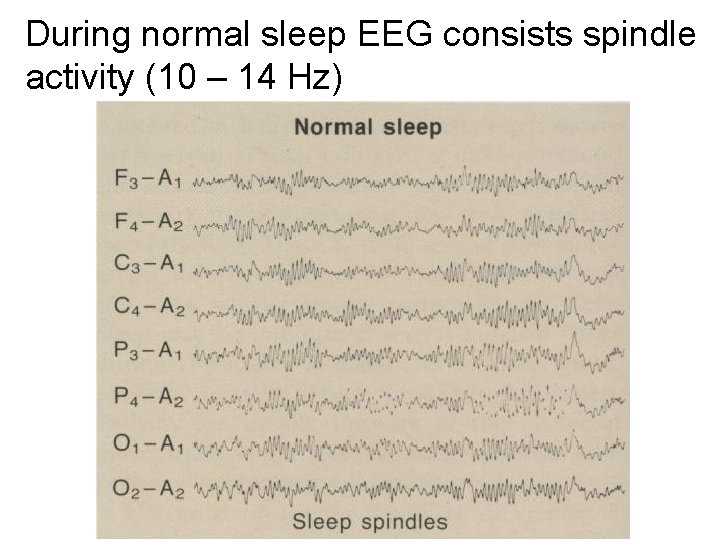 During normal sleep EEG consists spindle activity (10 – 14 Hz) 