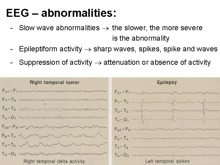 EEG – abnormalities: - Slow wave abnormalities the slower, the more severe is the