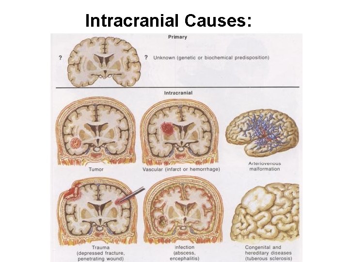 Intracranial Causes: 
