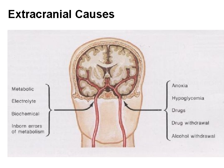 Extracranial Causes 