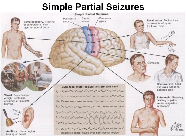 Simple Partial Seizures 