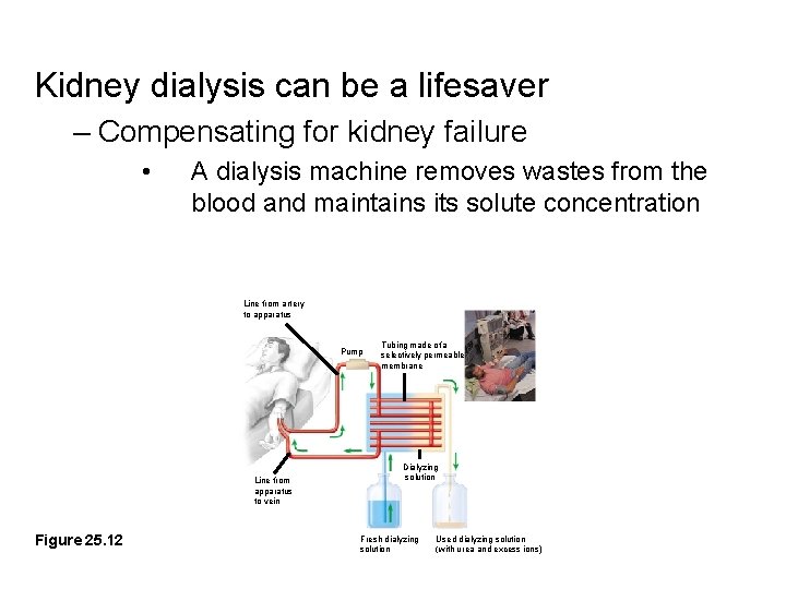 Kidney dialysis can be a lifesaver – Compensating for kidney failure • A dialysis Kidney dialysis can be a lifesaver – Compensating for kidney failure • A dialysis
