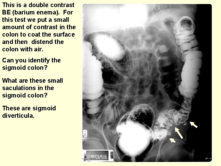 This is a double contrast BE (barium enema). For this test we put a