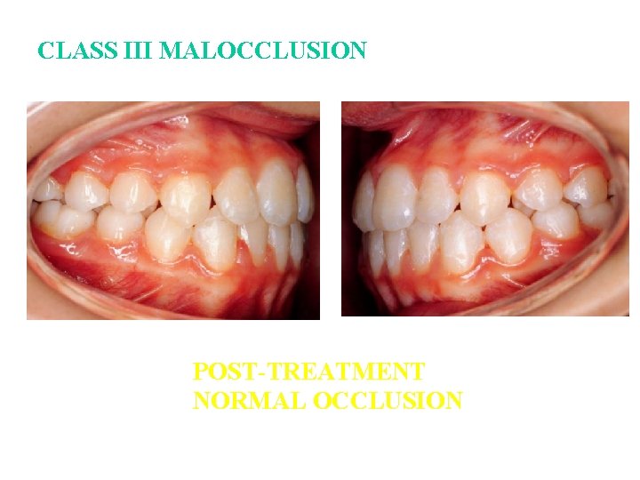 CLASS III MALOCCLUSION POST-TREATMENT NORMAL OCCLUSION CLASS III MALOCCLUSION POST-TREATMENT NORMAL OCCLUSION