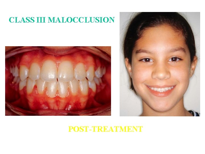 CLASS III MALOCCLUSION POST-TREATMENT CLASS III MALOCCLUSION POST-TREATMENT