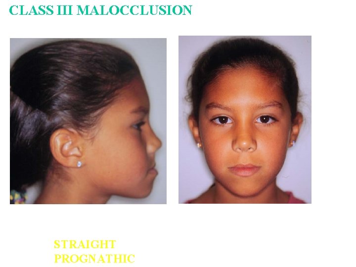 CLASS III MALOCCLUSION STRAIGHT PROGNATHIC CLASS III MALOCCLUSION STRAIGHT PROGNATHIC
