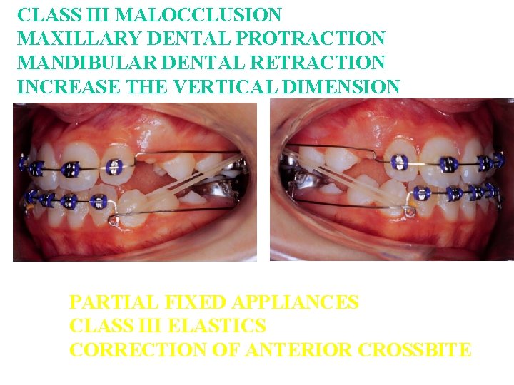 CLASS III MALOCCLUSION MAXILLARY DENTAL PROTRACTION MANDIBULAR DENTAL RETRACTION INCREASE THE VERTICAL DIMENSION PARTIAL CLASS III MALOCCLUSION MAXILLARY DENTAL PROTRACTION MANDIBULAR DENTAL RETRACTION INCREASE THE VERTICAL DIMENSION PARTIAL